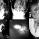 Radiografía con casos de Hirschsprung. Wikimedia Commons